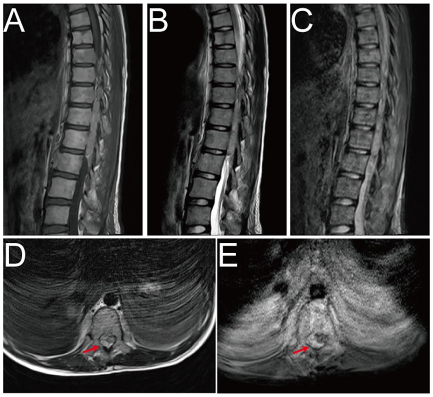 MRI scans of the spine and surrounding areas, labeled A through E. Images A, B, and C show sagittal views of the lumbar spine with varying levels of contrast and detail. Images D and E display transverse sections with a red arrow indicating a specific area of interest, possibly highlighting a lesion or abnormality.