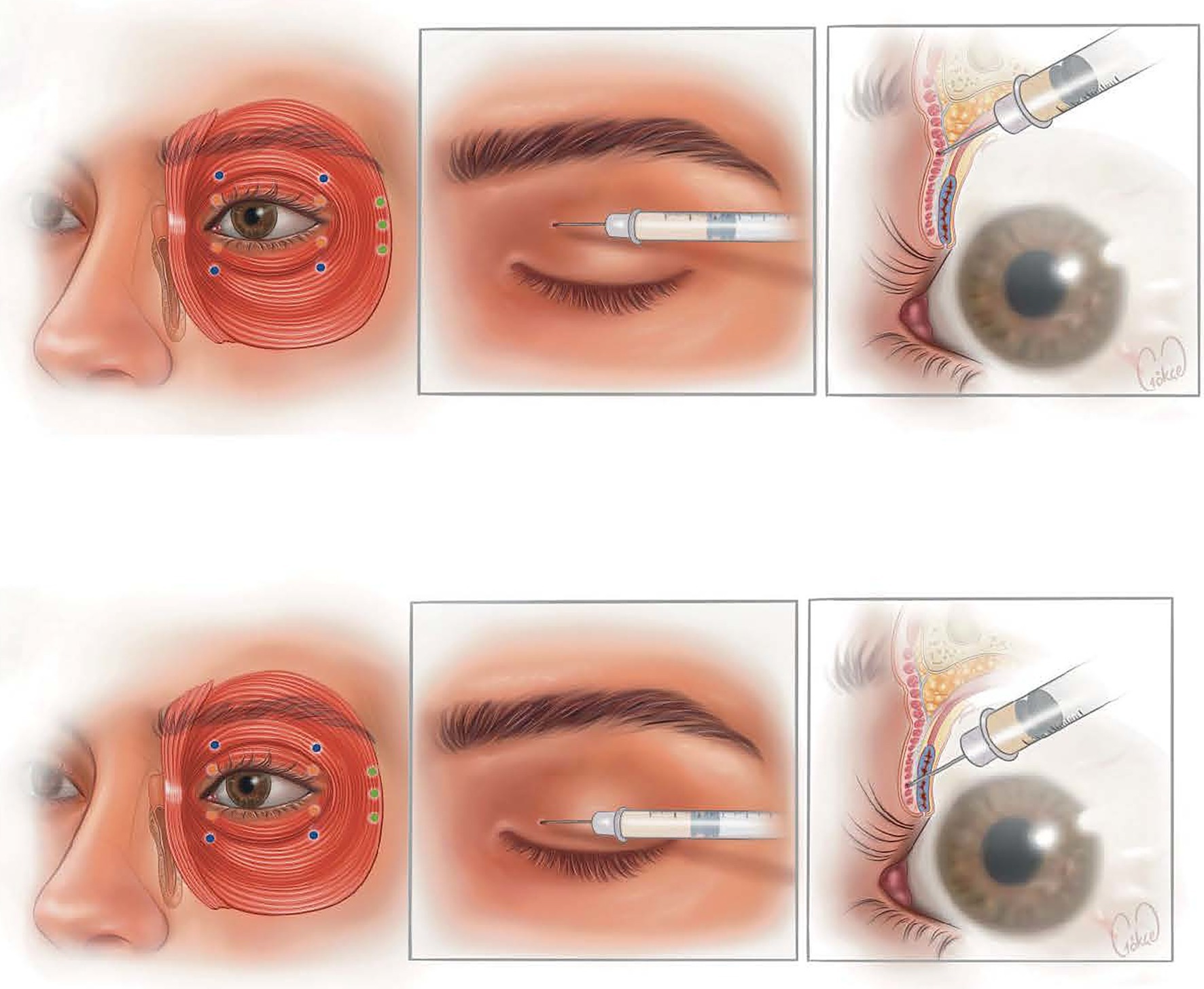 Illustration showing a medical procedure around the eye. The first panel depicts facial muscles marked with colored dots and lines. The second panel shows a syringe near a closed eye. The third panel illustrates an anatomical cross-section with a needle approaching the eye area. The bottom row repeats the same sequence, reinforcing the procedure steps.