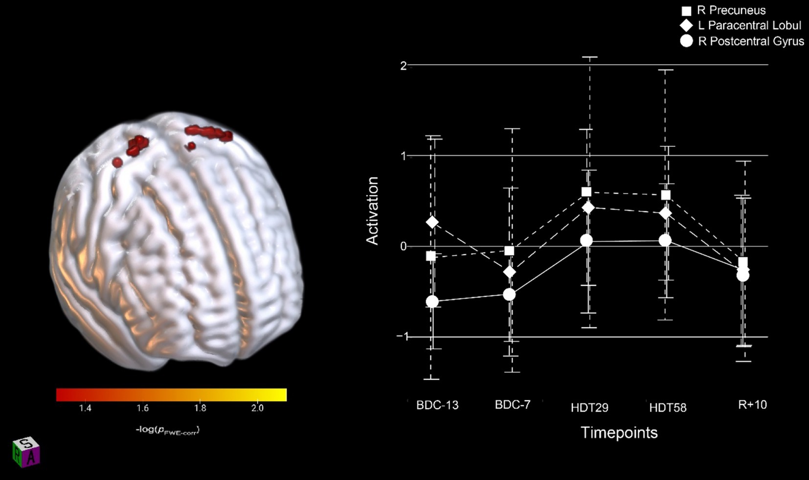 3D brain model with marked red areas indicating activation, shown alongside a line graph. The graph plots activation levels over time with data points for R Precuneus, L Paracentral Lobule, and R Postcentral Gyrus across specific timepoints BDC-13, BDC-7, HDT29, HDT58, and R+10. A color scale from red to yellow indicates significance levels.