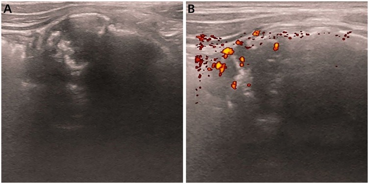 Two ultrasound images labeled A and B show a region with dense, irregular textures. Image A is a grayscale ultrasound, while image B includes areas highlighted in red and yellow, indicating increased blood flow or other activity.