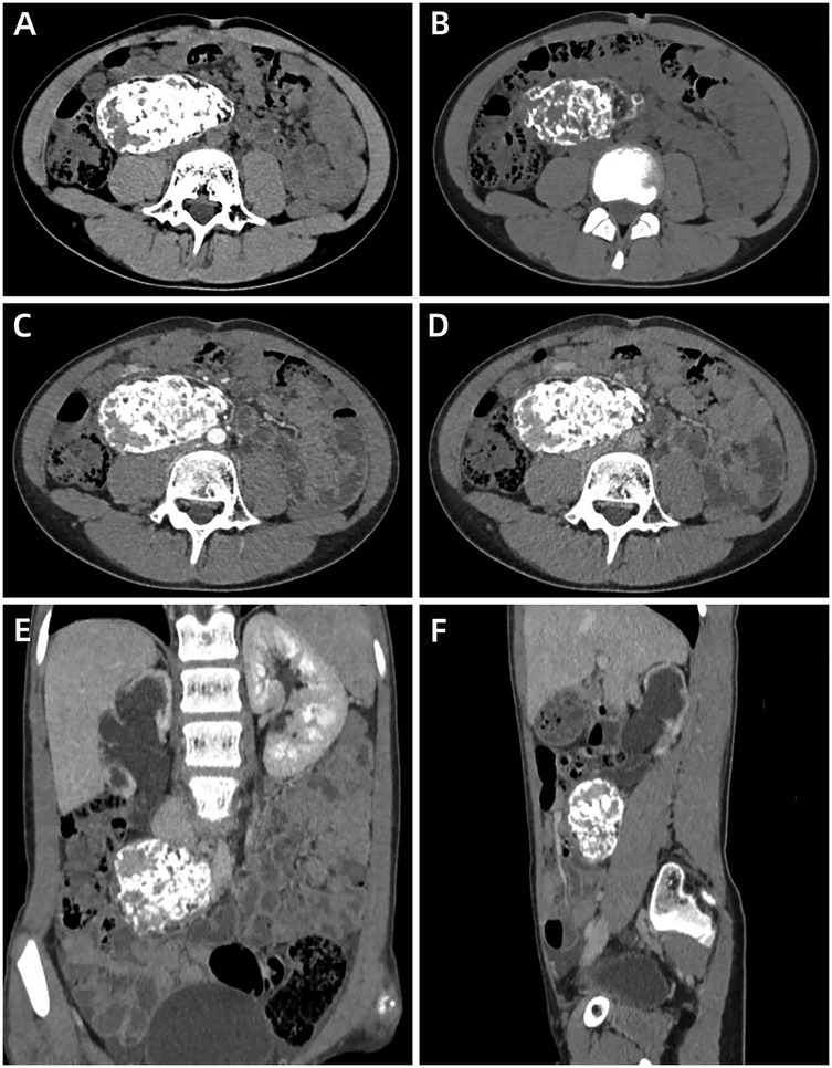 Six-panel medical imaging showing abdominal CT scans with varying orientations. Panels A to D present axial views illustrating a density variation in the abdomen. Panel E provides a coronal view, while Panel F offers a sagittal view, both highlighting abdominal structures and tissues with distinct density differences.