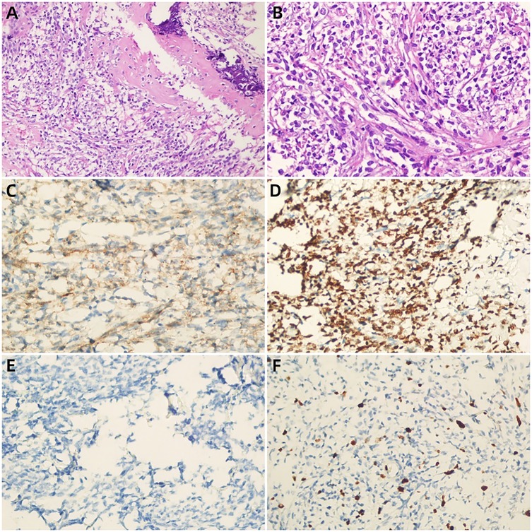 Histological images show different staining techniques. Image A and B display hematoxylin and eosin-stained tissues with dense cellular structures. Image C and D exhibit immunohistochemical staining with two distinct brown patterns. Image E and F present negative control and positive reactions with blue cellular background and scattered brown cells, respectively.