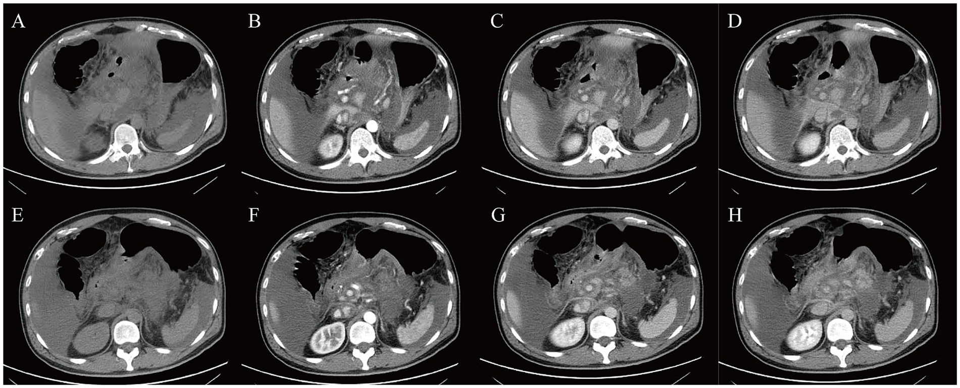 CT scan images labeled A to H showing cross-sectional views of the abdomen. Each image displays variations in soft tissue and organ structures. Differences in shading indicate tissue density, with visual changes observed across the sequence. Images depict abdominal anatomy, including the spine, organs, and soft tissues, highlighting their positioning and density in each scan.