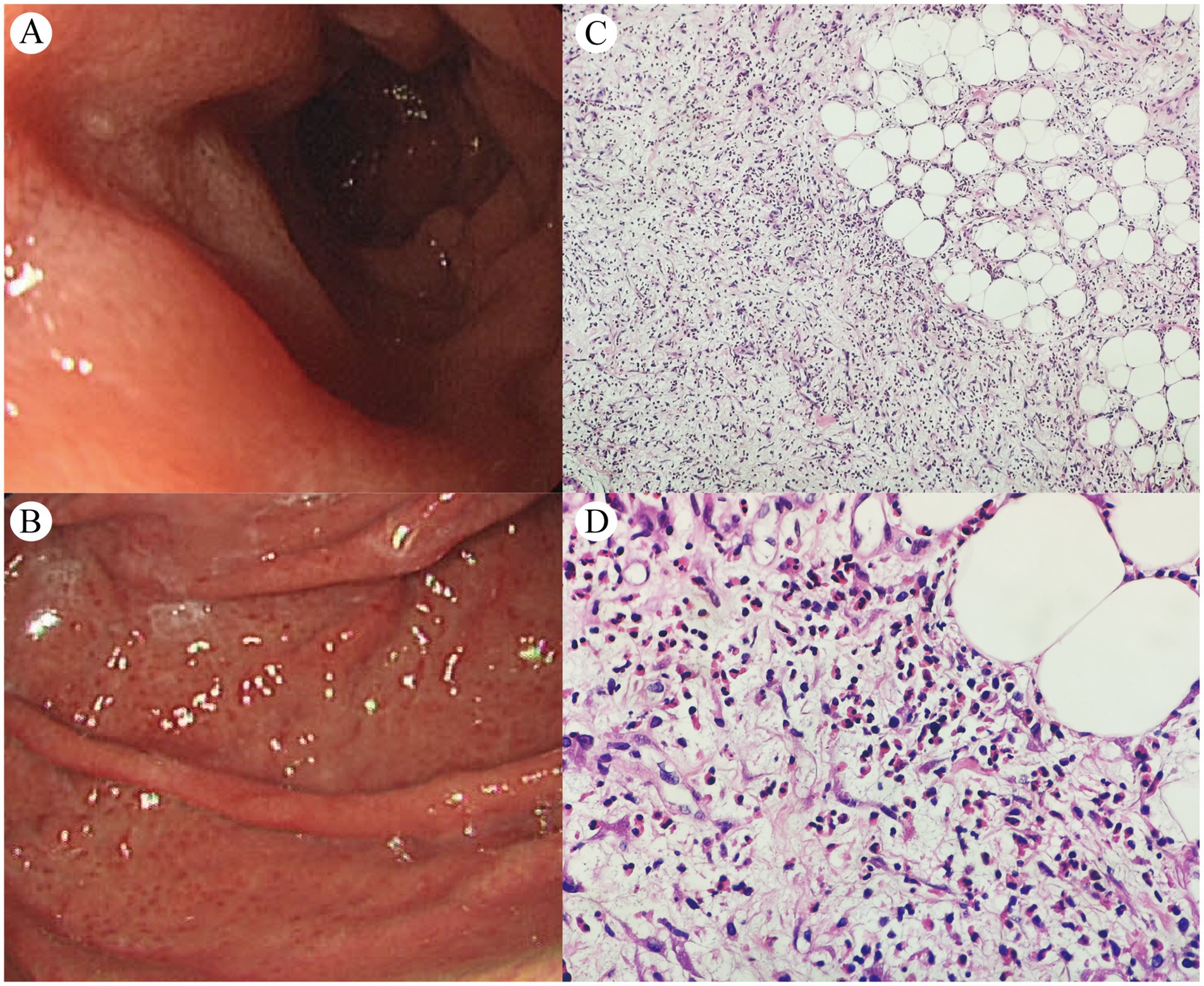 Panel A shows an endoscopic view of a hollow organ with visible walls. Panel B displays another endoscopic view with a shiny surface and visible folds. Panel C is a histological section showing fibrous tissue with round structures, possibly adipocytes. Panel D shows a closer view of the same tissue, highlighting cellular details and adipocytes.