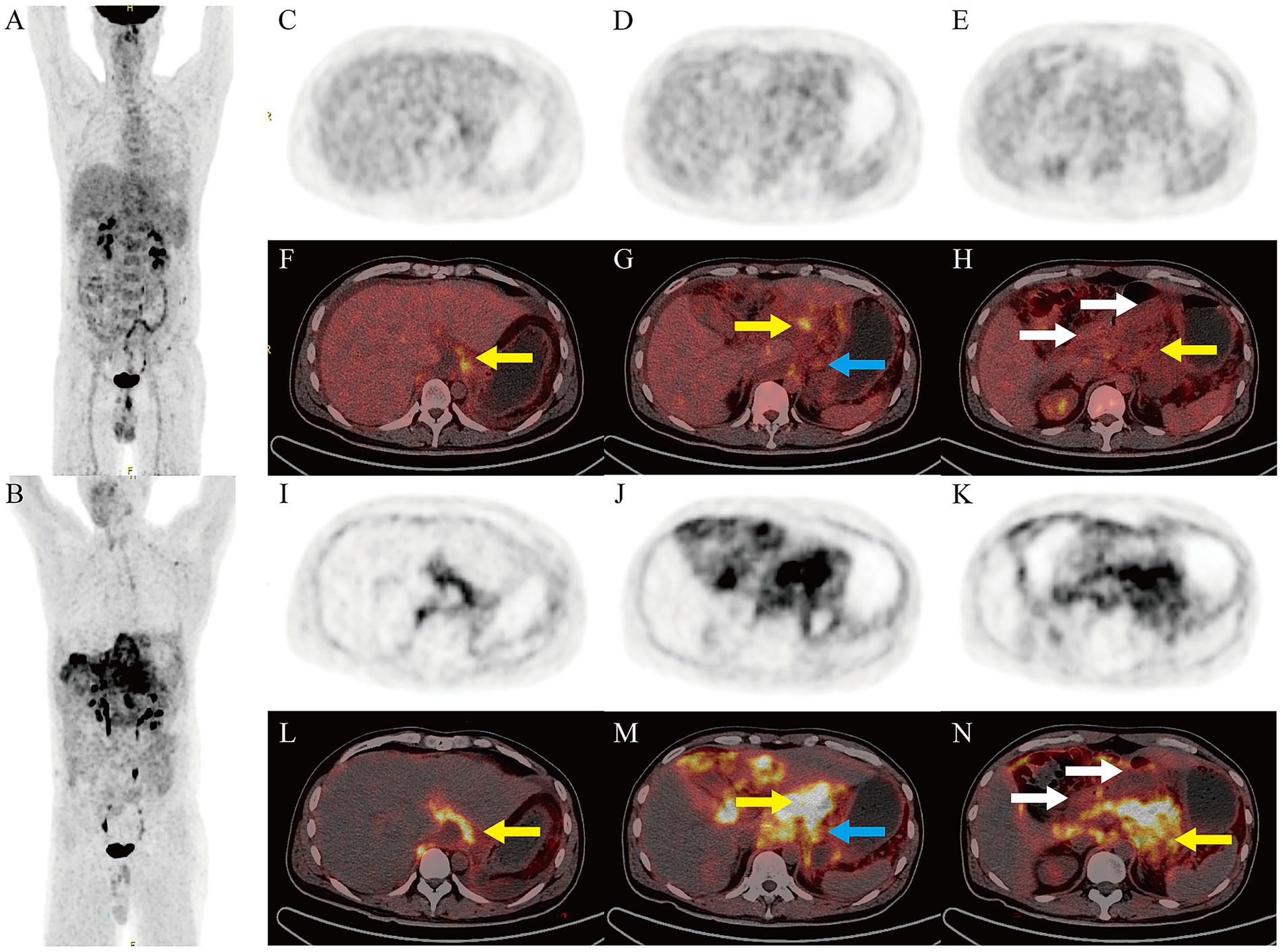 Medical imaging comparison of two patients. Images A and B are full-body scans, with B showing more defined dark areas. C, D, E, I, J, K are cross-sectional views. Panels F, G, H, L, M, N are enhanced liver scans with arrows highlighting specific areas in yellow, blue, and white, indicating differences in imaging, such as areas of interest or potential abnormalities.