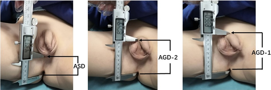 Three panels show measurements taken on an infant’s perineal area using digital calipers. The left panel is labeled ASD, measuring dimensions beside the scrotum. The middle panel is labeled AGD-2, and the right panel is labeled AGD-1, indicating measurements from the anus towards different points on the body