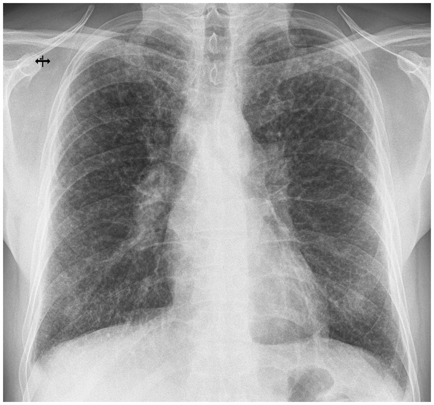 Chest X-ray showing the frontal view of the rib cage, heart, and lungs. The image includes clear visibility of the spine and clavicles. The lungs appear dark with interspersed lighter areas representing bones and tissues.