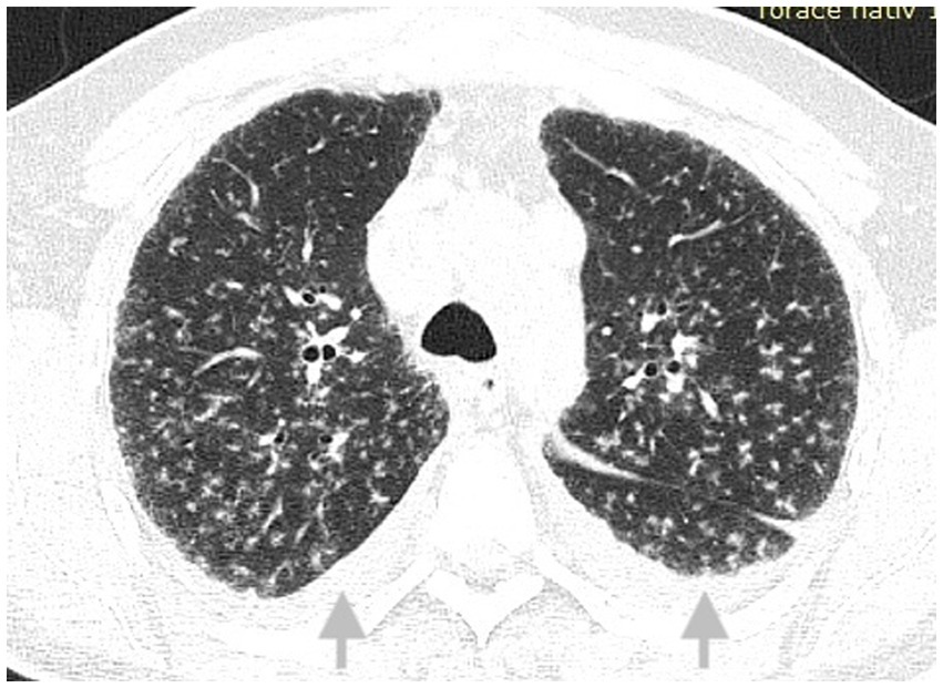 CT scan of the chest showing lung tissue with prominent dark areas indicating air spaces. The bronchi and vascular structures are visible. Arrows point to areas at the lung bases.