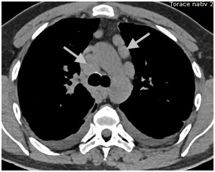 CT scan of the chest showing a cross-sectional view of the thoracic cavity. Two arrows point to areas of interest near the center, likely indicating enlarged lymph nodes or masses in the mediastinum. Bone structures and lung areas are visible in contrasting shades.