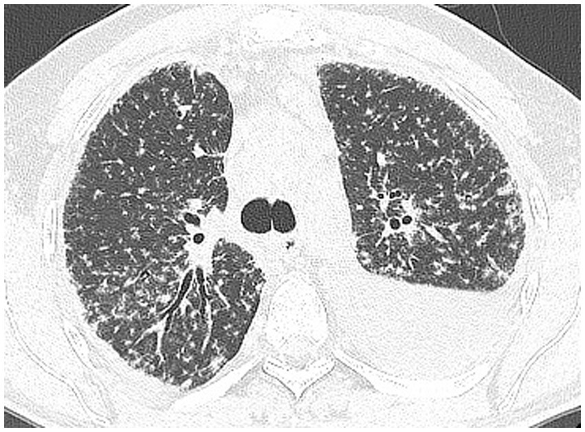 CT scan of lung anatomy showing two dark, circular lung areas separated by the mediastinum. The lung tissue has a speckled appearance indicative of various densities.
