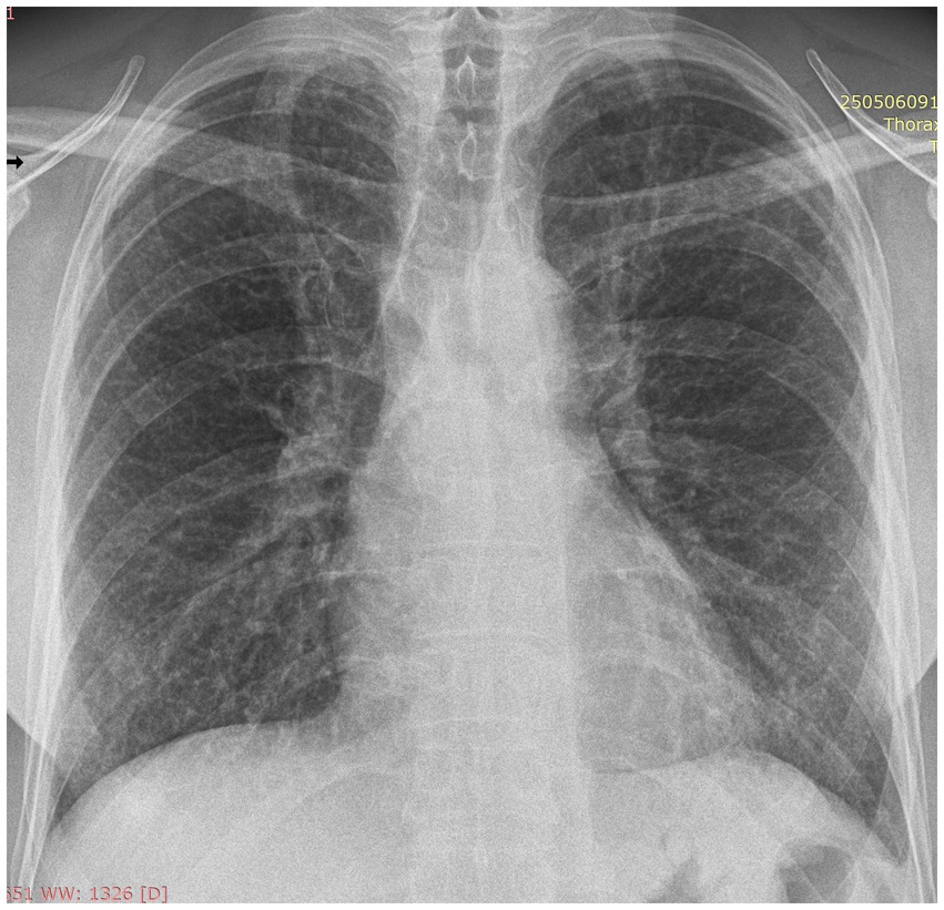 Chest X-ray showing the thoracic cavity, including both lungs, ribs, and spine. Clear visualization of lung fields and vascular markings. The diaphragm is seen at the bottom.