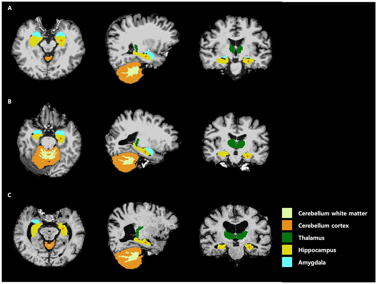 Sequential images illustrating steps in brain MRI analysis: 1) Weighted T1 scan, 2) Skull stripping, 3) Volumetric labeling, 4) Intensity normalization, 5) White matter segmentation, 6) Surface atlas registration, 7) Surface extraction, 8) Cortical parcellation.