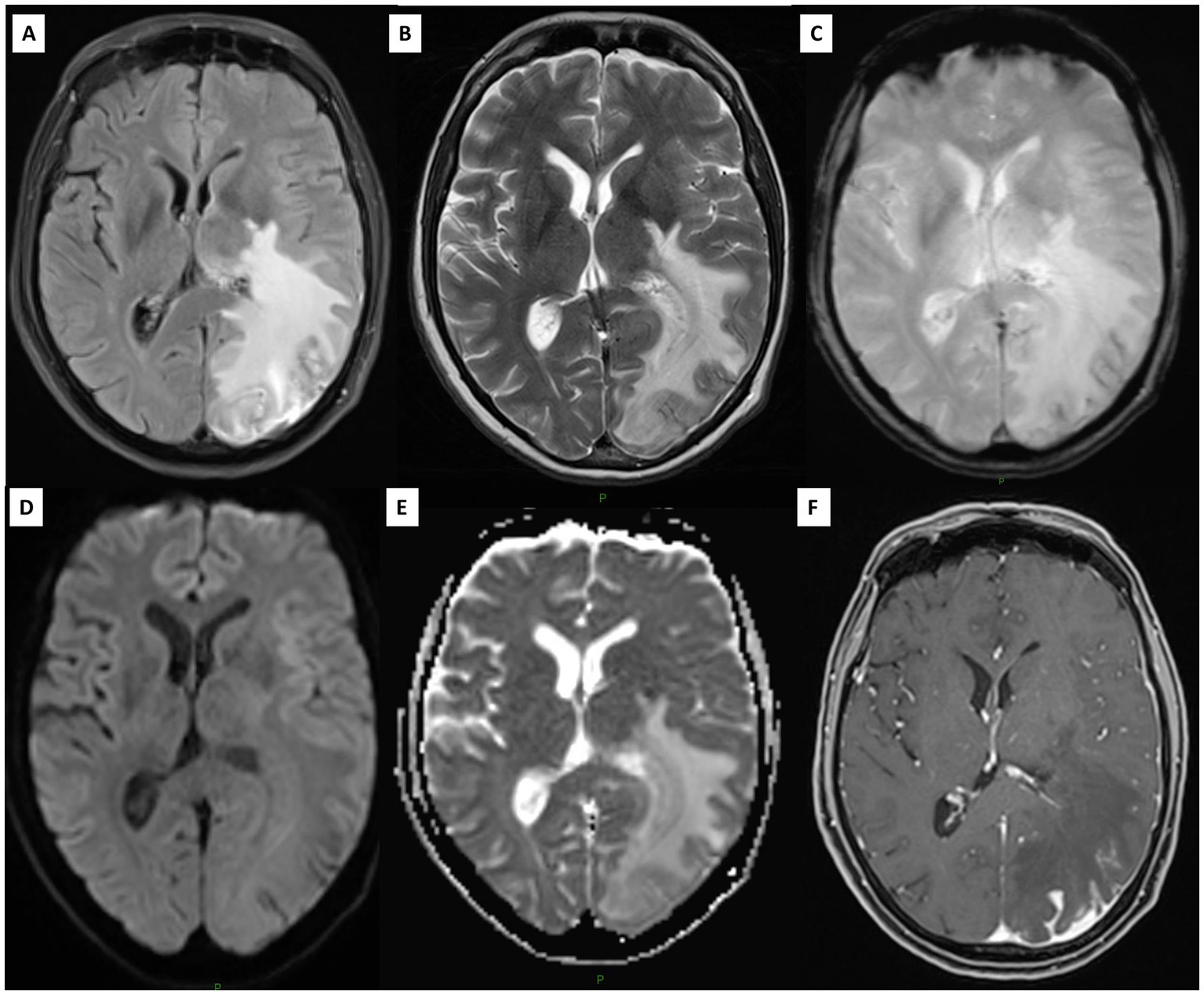 Six MRI brain scans labeled A to F, showing different imaging techniques. The scans display various regions of the brain with differences in intensity and contrast, likely highlighting areas for medical assessment. Scans include axial cuts with varying signal intensities, suggesting examination of possible abnormalities. Each image offers distinct visual information for comparative analysis.