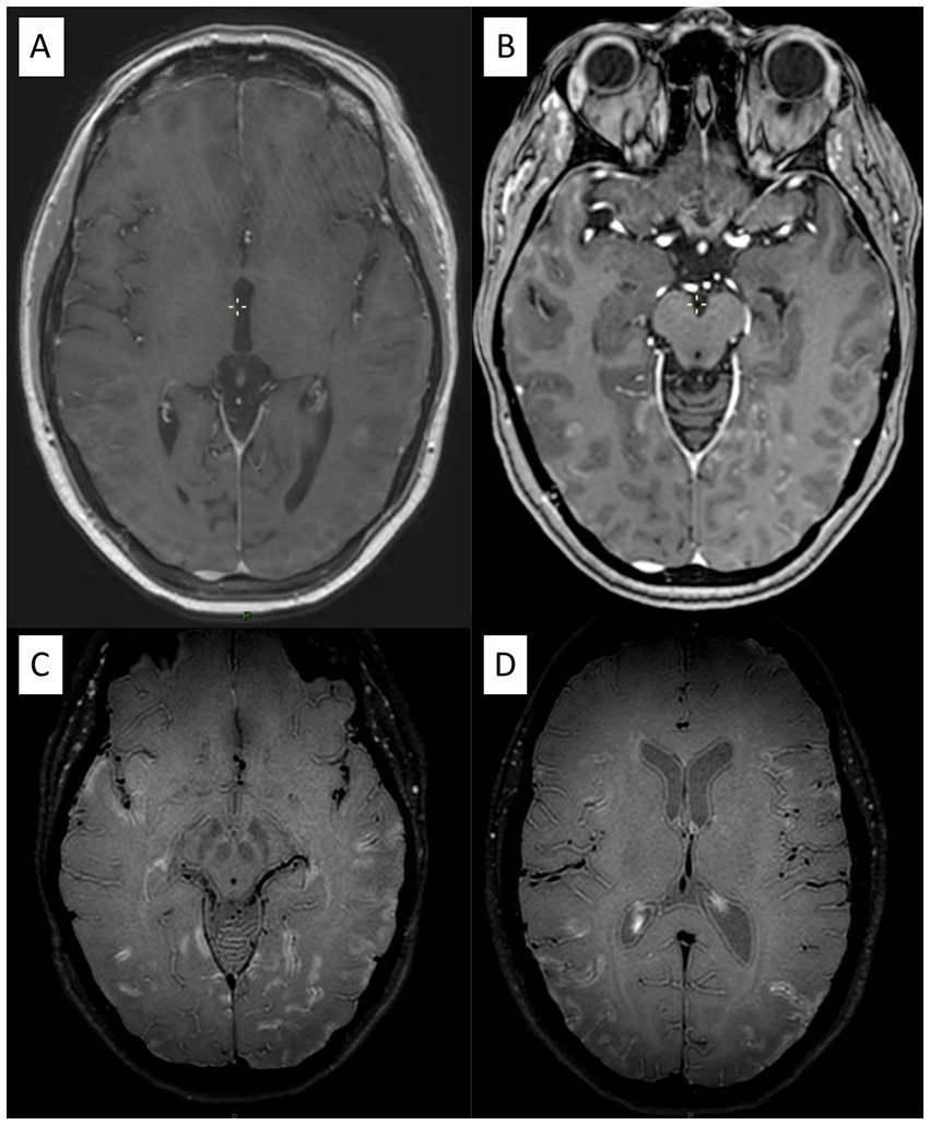 Four-panel MRI scans of the brain labeled A, B, C, and D. Panel A shows an axial T1-weighted image with contrast, B shows a similar slice with the orbits visible. C and D display different slices using a T2-weighted sequence, highlighting brain structures and contrast between tissues.