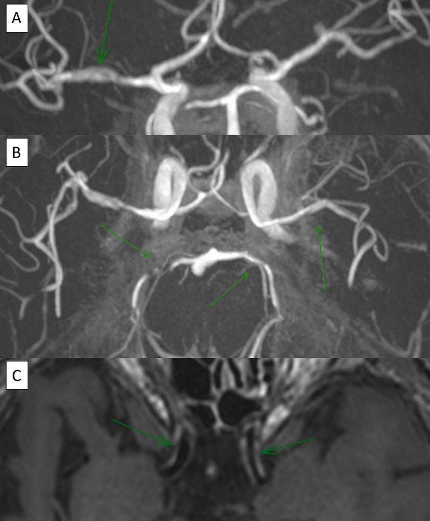 Three-part MRI scan of cerebral arteries. Image A shows an artery with a green arrow indicating a section. Image B highlights additional arteries with green arrows pointing to specific areas. Image C shows another view with green arrows indicating certain features.