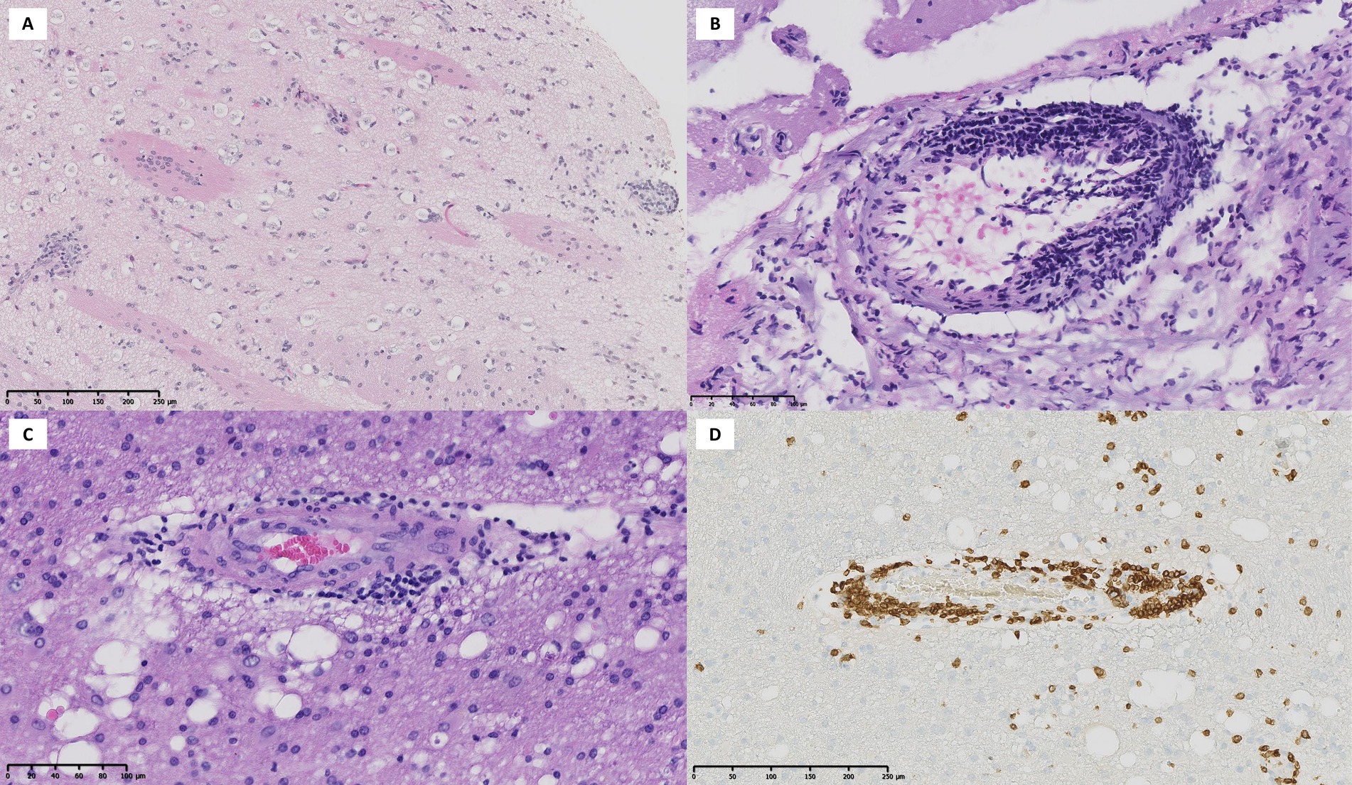 Four microscopic images show brain tissue sections labeled A, B, C, and D. A shows a low magnification of gray matter with scattered nuclei. B features a blood vessel with dense inflammatory infiltrate. C highlights a higher magnification of another vessel with prominent lymphocytes. D displays a section with immunohistochemical staining, identifying specific cell markers in brown. Scale bars are present in each image.
