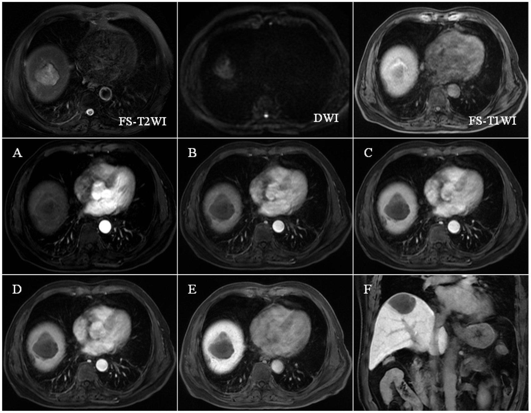 MRI scans showing different phases and techniques of liver imaging. Top row includes FS-T2WI, DWI, and FS-T1WI images. Middle row labeled A, B, C, and bottom row D, E shows contrast-enhanced sequences. Panel F shows a coronal positions. A liver lesion is visible, showing varying signal intensities in different phases.