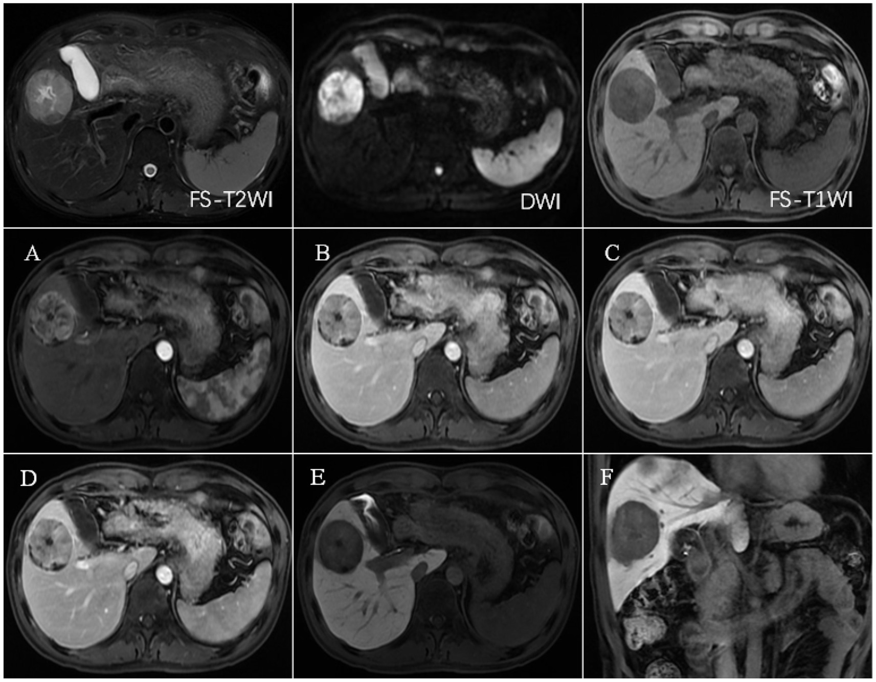 A series of abdominal MRI scans displaying different imaging techniques and phases. The first row shows FS-T2WI, DWI, and FS-T1WI images. The second row presents images labeled A through F, representing different scan timings or enhancements. Each image highlights liver structures and a noticeable lesion on the liver.