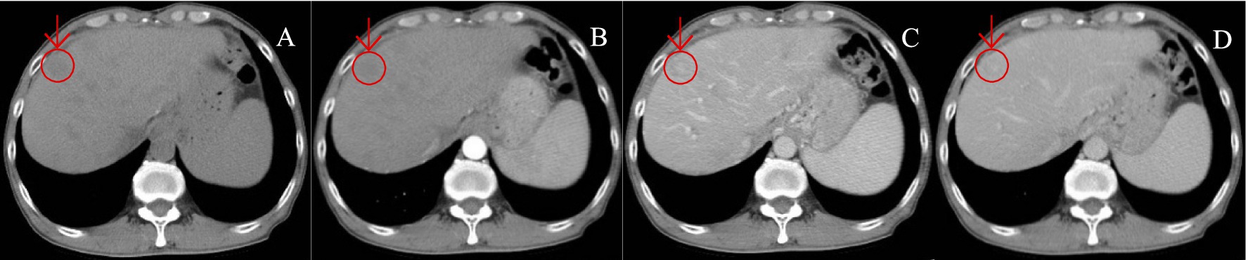 CT scans labeled A to D show the liver with a red circle and arrow highlighting a specific area. Each scan has slight differences in shading and contrast, indicating various imaging phases or techniques.