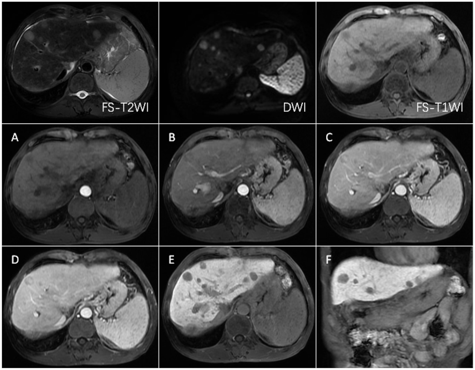 A series of six MRI images of the liver. The top row shows FS-T2WI, DWI, and FS-T1WI scans. The bottom row has four images labeled A to F, showing different stages or angles. Each image highlights varying shades of gray, indicating liver tissues and structures.
