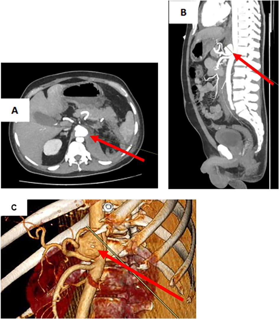 CT images of the abdomen and thorax are shown. Panel A displays an axial view with an arrow pointing to an area near the aorta. Panel B shows a sagittal section highlighting vessels with a red arrow. Panel C provides a 3D reconstruction focusing on the aortic region with an arrow indicating a specific vascular structure.