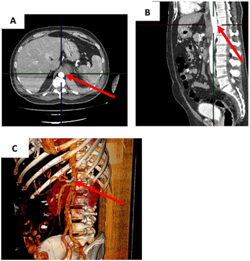 Panel A shows an axial CT scan with a red arrow pointing to a vascular structure. Panel B displays a sagittal CT scan highlighting a different section of the spine with a red arrow. Panel C is a 3D reconstruction of the thoracic region showing ribs and arteries, with a red arrow indicating a specific location.