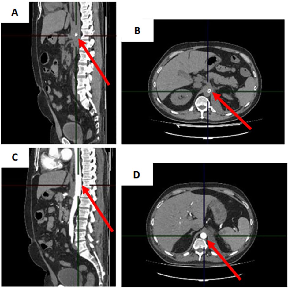 CT scan images labeled A, B, C, and D. Panels A and C show sagittal views of the spine with arrows pointing to the spinal column. Panels B and D show axial cross-sections of the abdomen with arrows indicating a specific area near the spinal cord.