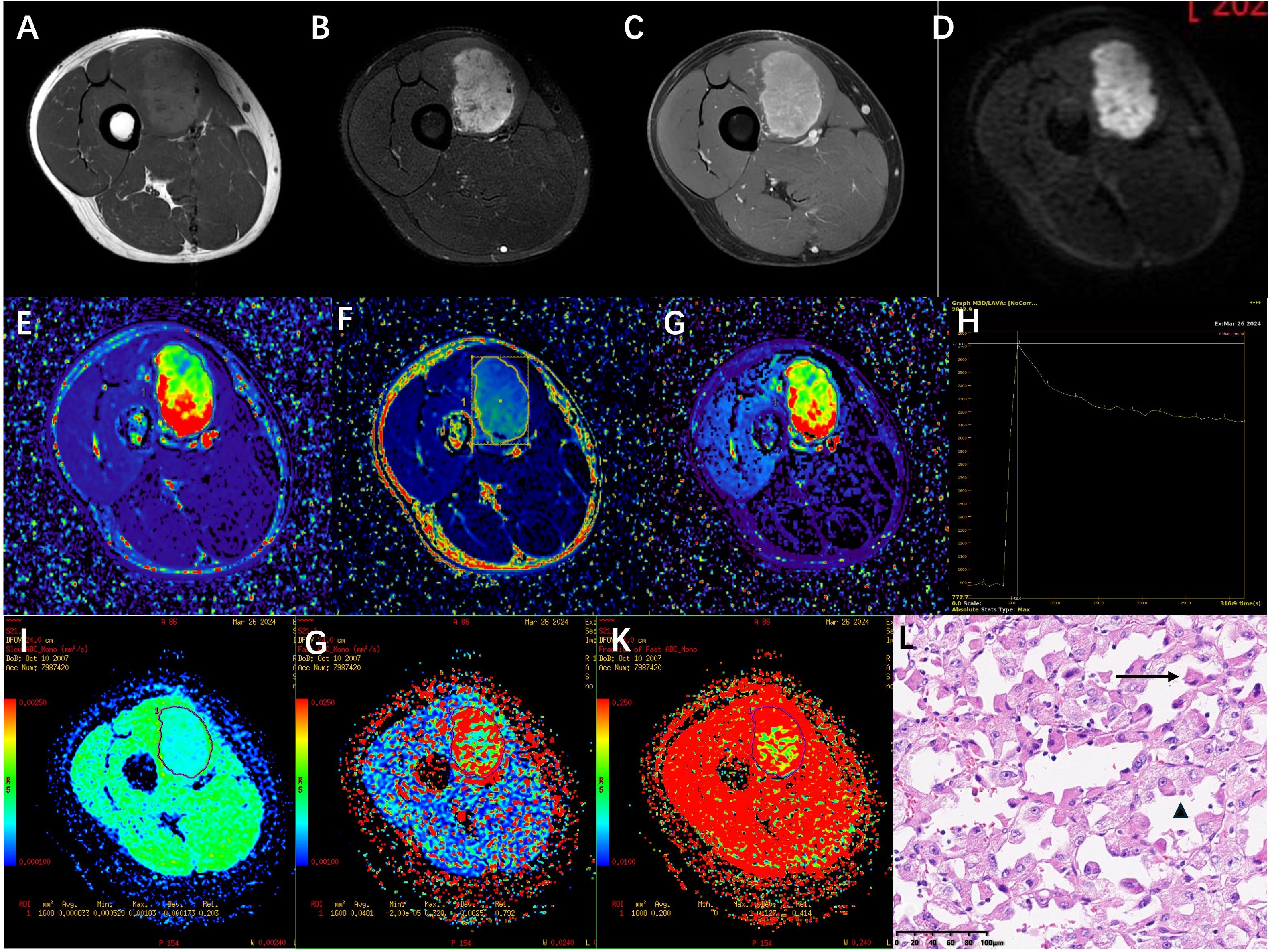 Medical imaging of a leg showing various scans in panels A to L. A, B, and C display MRI views with different contrast levels highlighting a mass. D shows a diffusion-weighted image. E, F, and G present color-coded maps, possibly perfusion or diffusion-related. H displays a graph with a line plot, likely showing a specific measurement over time. I, G, and K are additional specialized maps with distinct color scales. L is a histological image showing tissue structure stained for microscopic examination. Each panel illustrates different diagnostic aspects of the suspected abnormality.