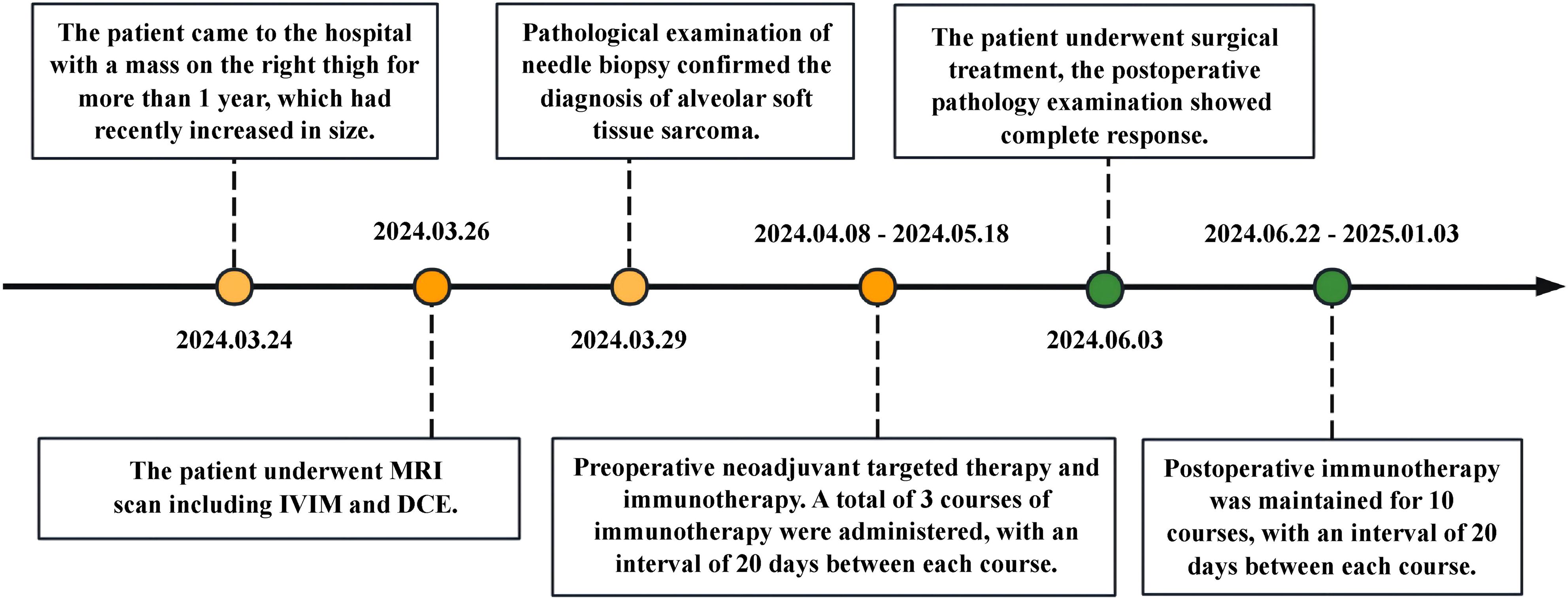 Timeline detailing a patient's medical journey for a right thigh mass. Key dates include: March 24, 2024, MRI scan; March 26, 2024, biopsy diagnosis of sarcoma; March 29, 2024, preoperative therapy; April 8 to May 18, 2024, additional treatment; June 3, 2024, surgery showing complete response; June 22, 2024, to January 3, 2025, postoperative immunotherapy.