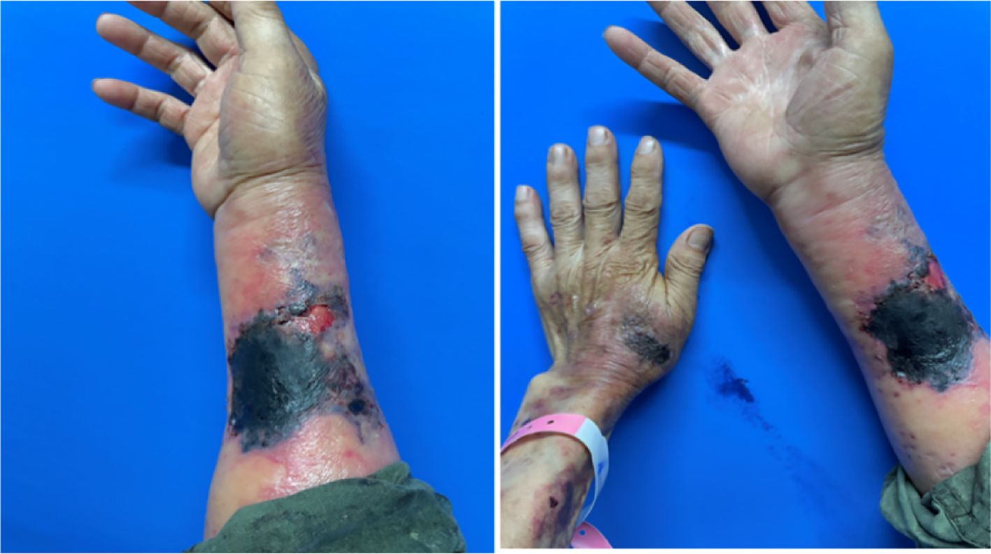 A side-by-side comparison shows a forearm with extensive skin damage and discoloration on a blue background. The left image presents a partially closed hand, revealing areas of red inflamed skin with large dark patches, indicative of a severe skin condition or burn. The right image shows the same forearm, with the hand slightly more open, showcasing similar dark discolorations and inflammation. A wristband is visible on the wrist in the right image.