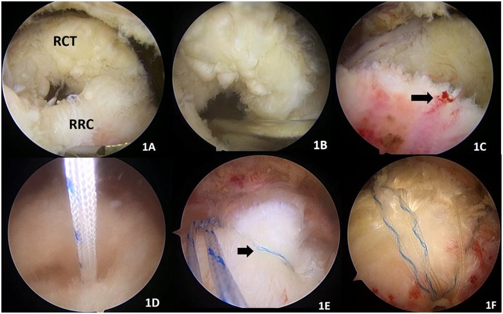Arthroscopic images illustrating rotator cuff repair. Image 1A shows rotator cuff tear (RCT) and residual rotator cuff (RRC). Image 1B highlights the tear. Image 1C shows a suture anchor site with bleeding, marked by an arrow. Image 1D depicts a suture passing through the tendon. Image 1E indicates suture placement with an arrow. Image 1F shows the completed suture repair with clear stitching lines.