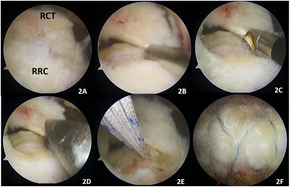 Six-panel graphic illustrating surgical views of a rotator cuff tear (RCT) and rotator cuff repair (RCR). Panel 2A shows the torn cuff, 2B and 2C depict surgical tools in use, 2D illustrates further tool application, 2E shows the suturing process, and 2F displays the completed repair with visible sutures.