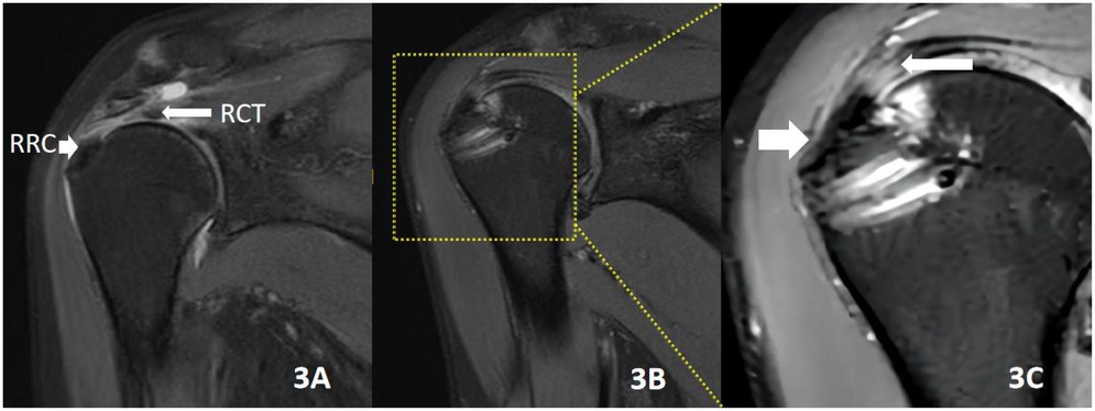 Three MRI scans of a shoulder showing a rotator cuff tear (RCT). Image 3A highlights the rotator cuff with an arrow labeled RRC pointing to it. Image 3B shows a zoomed-in section with a dotted box. Image 3C focuses on the tear with an arrow emphasizing the torn area.