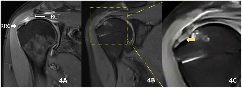 Three MRI images showing a shoulder’s rotator cuff. The first image (4A) highlights the rotator cuff (RCT) and rotator cuff repair (RRC). The second image (4B) zooms in on the shoulder. The third image (4C) further magnifies, with a yellow arrow indicating a specific area of interest.