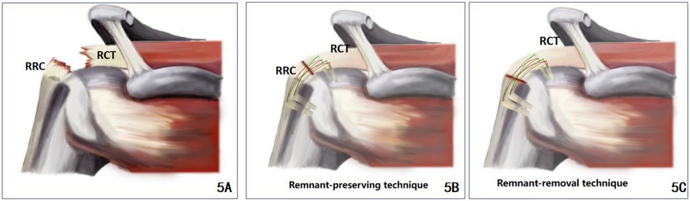 Illustration of shoulder repair techniques. Panel 5A shows a rotator cuff tear (RCT) and remaining rotator cuff (RRC). Panel 5B displays the remnant-preserving technique with arcs indicating suture paths. Panel 5C depicts the remnant-removal technique with similar arcs.