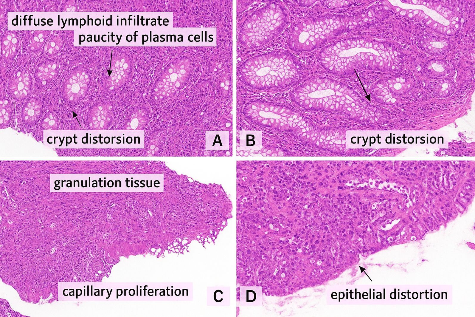 Histological slides illustrating various tissue conditions. Panel A shows diffuse lymphoid infiltrate and paucity of plasma cells with crypt distortion. Panel B highlights crypt distortion. Panel C depicts granulation tissue and capillary proliferation. Panel D indicates epithelial distortion. All panels are stained for detailed cellular structure.