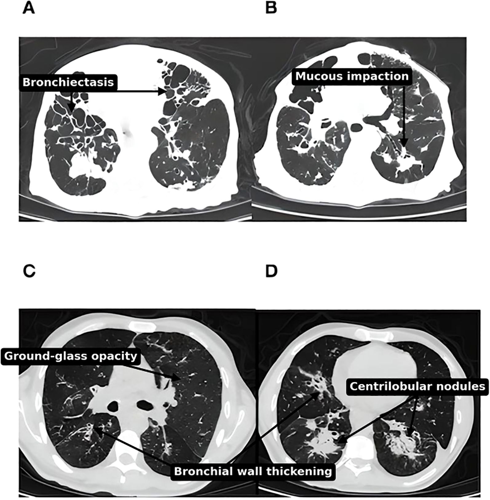 Four CT scan images showing different lung conditions. Image A highlights bronchiectasis with dilated airways. Image B indicates mucous impaction within the airways. Image C shows ground-glass opacity and bronchial wall thickening in the lung tissue. Image D identifies centrilobular nodules, suggesting possible inflammation or infection.