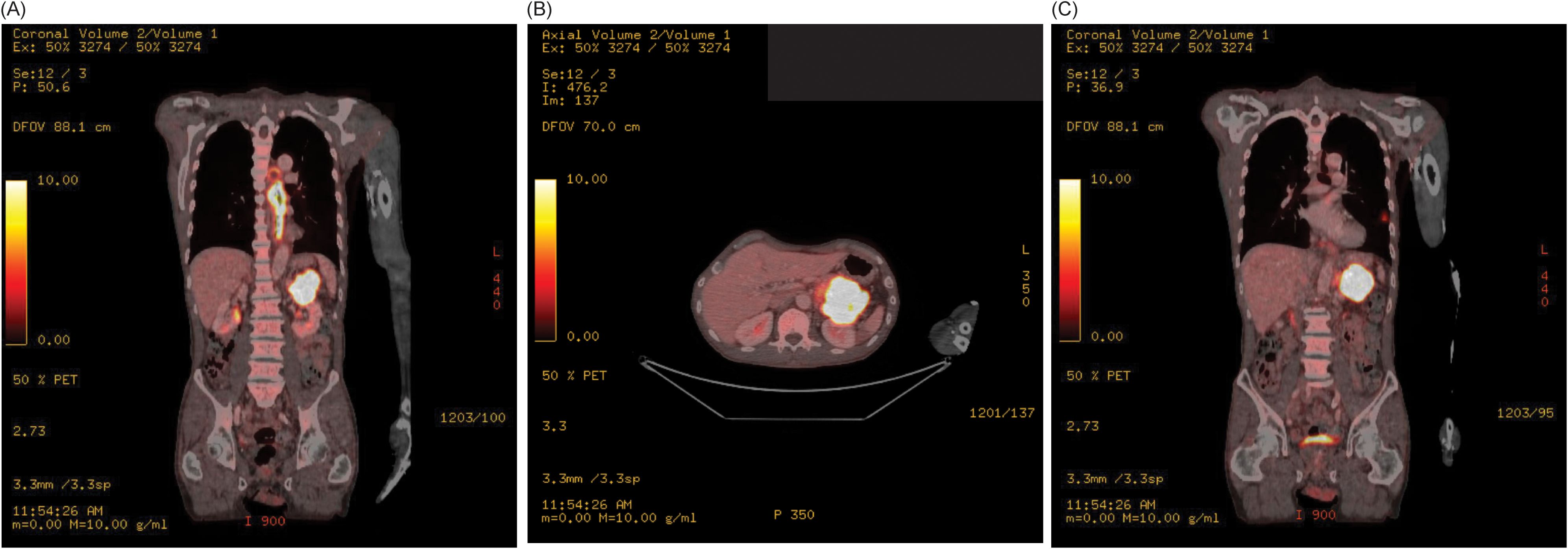Three-panel PET scans display different views of the abdomen with color gradients indicating metabolic activity. Panel (A) and (C) show coronal views, while panel (B) presents an axial view. High activity regions are highlighted in bright colors.