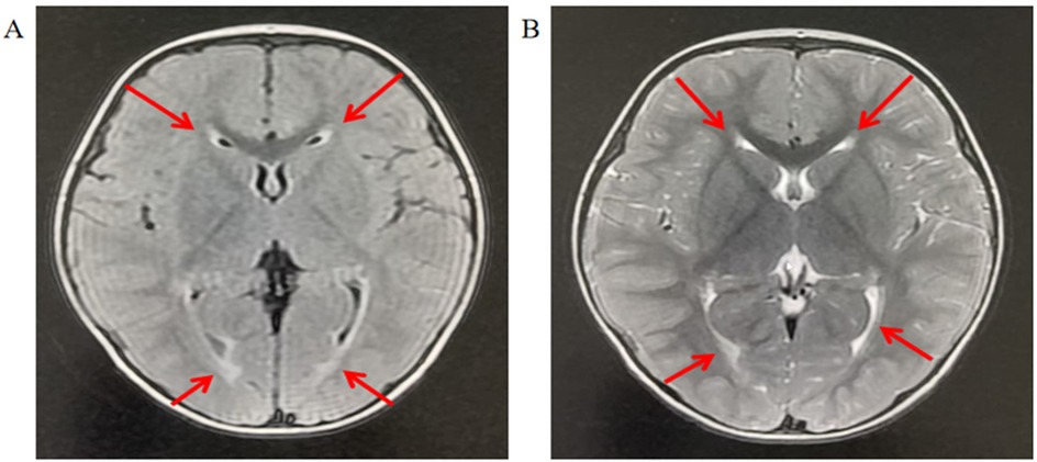 Two MRI scans labeled A and B, showing axial views of a brain. Red arrows indicate specific regions in each scan. Scan A shows arrows pointing at areas of possible interest in a darker-toned brain tissue image. Scan B highlights similar regions with arrows in a slightly lighter-toned tissue image with more pronounced structures.