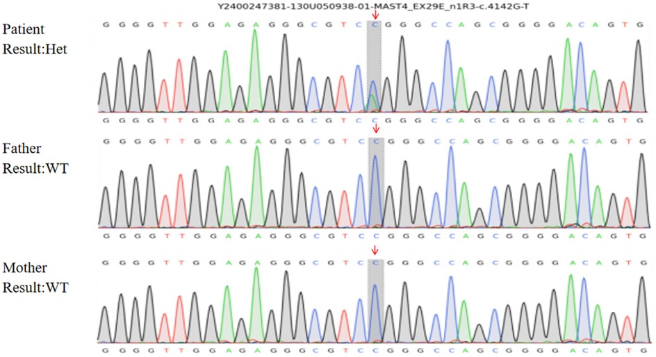 Electropherogram showing DNA sequencing results for a patient and their parents. The patient displays heterozygous (Het) mutation with overlapping peaks at a specific point, indicated by an arrow. Both parents show wild type (WT) results with consistent single peaks. The G to T transition is highlighted for the patient, differing from the parents.