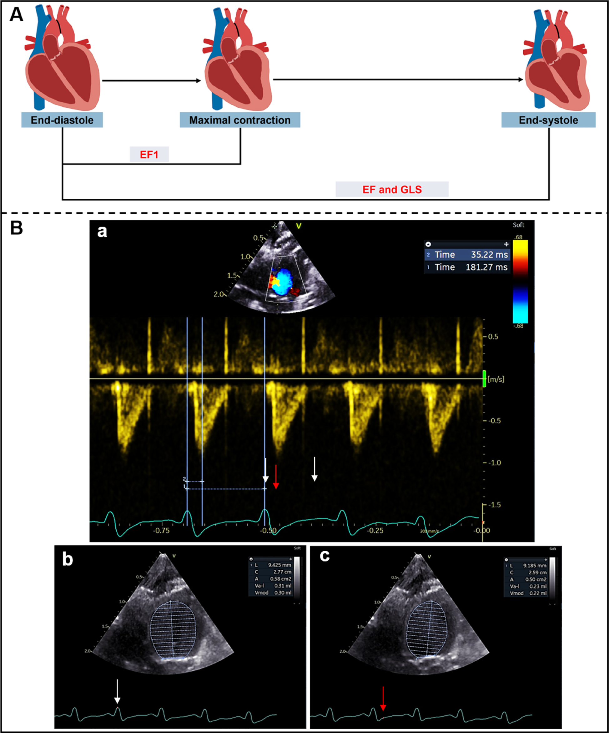 Composite figure illustrating cardiac function assessment using echocardiography. Panel A shows schematic diagrams of the heart at end-diastole, maximal contraction, and end-systole, highlighting that EF1 is measured at maximal contraction, while ejection fraction (EF) and global longitudinal strain (GLS) are calculated at end-systole. Panel B includes three echocardiographic images: (a) tissue Doppler trace with timing markers for early systolic ejection (red arrow) and end-systole (white arrow); (b) two-dimensional image showing end-diastolic volume measurement; and (c) image at maximal contraction representing EF1, with corresponding ECG points marked by arrows.