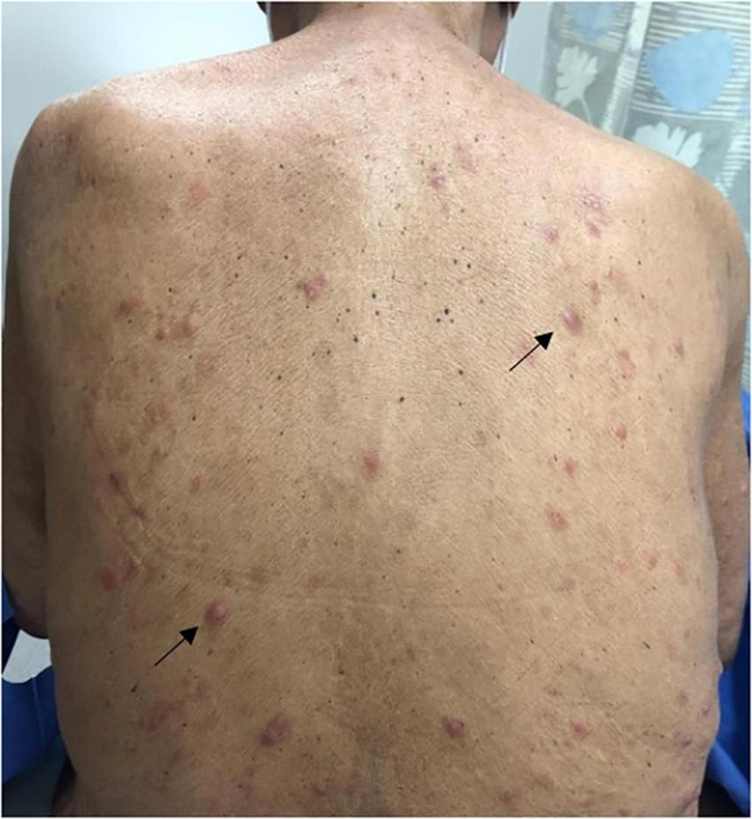 A person’s back shows numerous reddish bumps and lesions scattered across the skin. Two arrows point to specific spots, indicating areas of interest or concern. The background includes a blurred curtain.