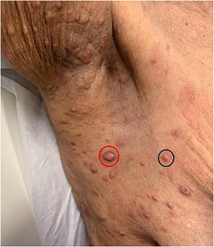 Skin displaying numerous raised bumps of varying sizes, some circled in red and black for emphasis. The image highlights differences in the appearance of these lesions.