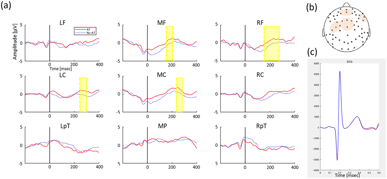 Heartbeat-evoked potentials (HEPs) data visualization with three sections: (a) Nine line graphs showing amplitude in microvolts over time across different brain regions, including LF, MF, RF, LC, MC, RC, LpT, MP, and RpT, with colored lines and shaded areas highlighting differences between AT and No-AT conditions. (b) Diagram of a head with electrode positions marked, indicating focus areas. (c) ECG graph plotting signal amplitude over time, indicating correlation with EEG data.