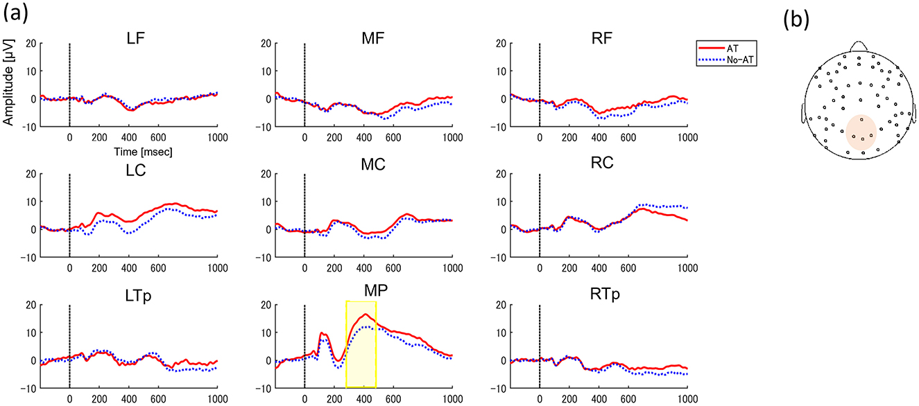 Event-related potentials (ERPs) data visualization with two sections:(a) Nine line graphs showing amplitude over time from 0 to 1000 milliseconds for different brain regions: LF, MF, RF, LC, MC, RC, LTp, MP, and RTp. Red lines (AT) and blue dashed lines (No-AT) represent different conditions. A significant divergence in the MP graph is highlighted with a yellow box. On the right (b) is a diagram of a head with dots indicating electrode positions, highlighting the topography of MP region.