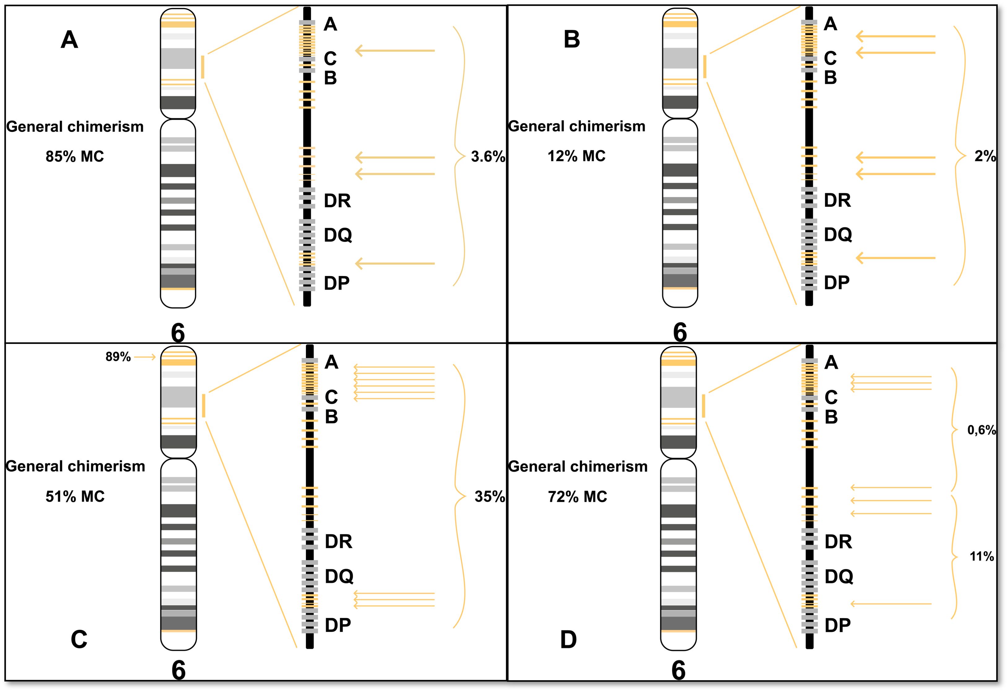Four-panel diagram comparing chromosome 6 chimerism across different samples. Panel A shows 85% microchimerism; Panel B shows 12% with 2% detailed chimerism; Panel C shows 51% with 35% detailed chimerism, and Panel D shows 72% with 11% detailed chimerism. All panels highlight gene regions A, C, B, DR, DQ, and DP.