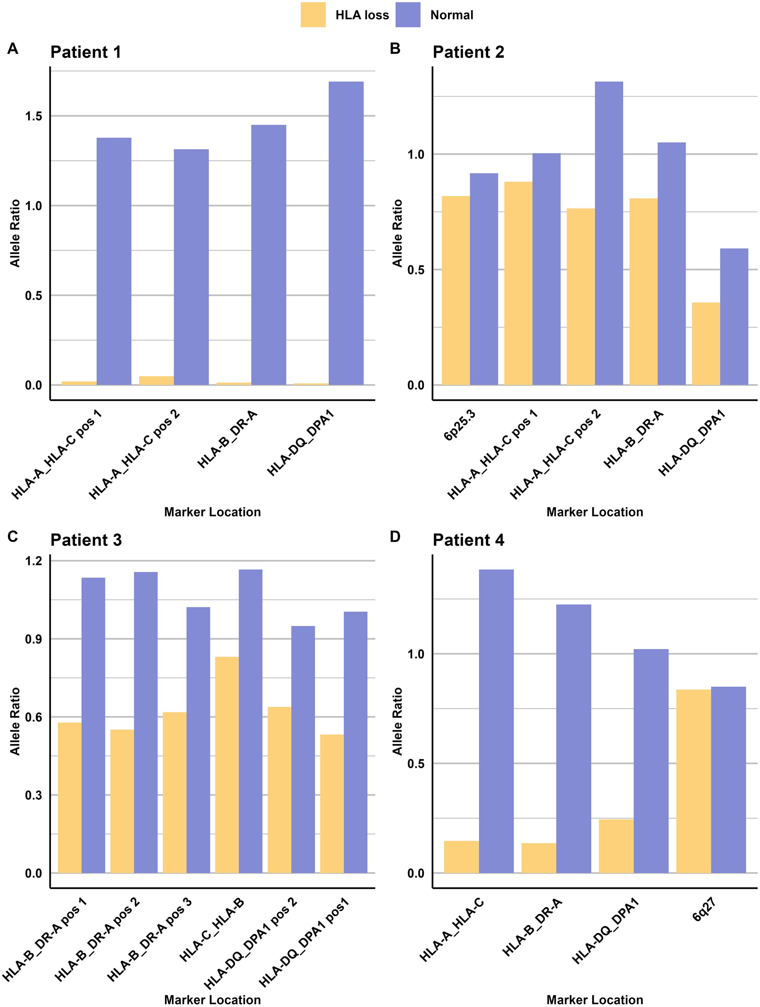 Bar charts show allele ratios for four patients across different marker locations. Patients exhibit variations in HLA loss and normal alleles. Each chart displays orange for HLA loss and blue for normal. Patient 1 has consistent high normal ratios. Patient 2 shows mixed values, with some HLA loss. Patient 3 displays moderate HLA loss across markers. Patient 4 has mixed allele ratios with noticeable variations.