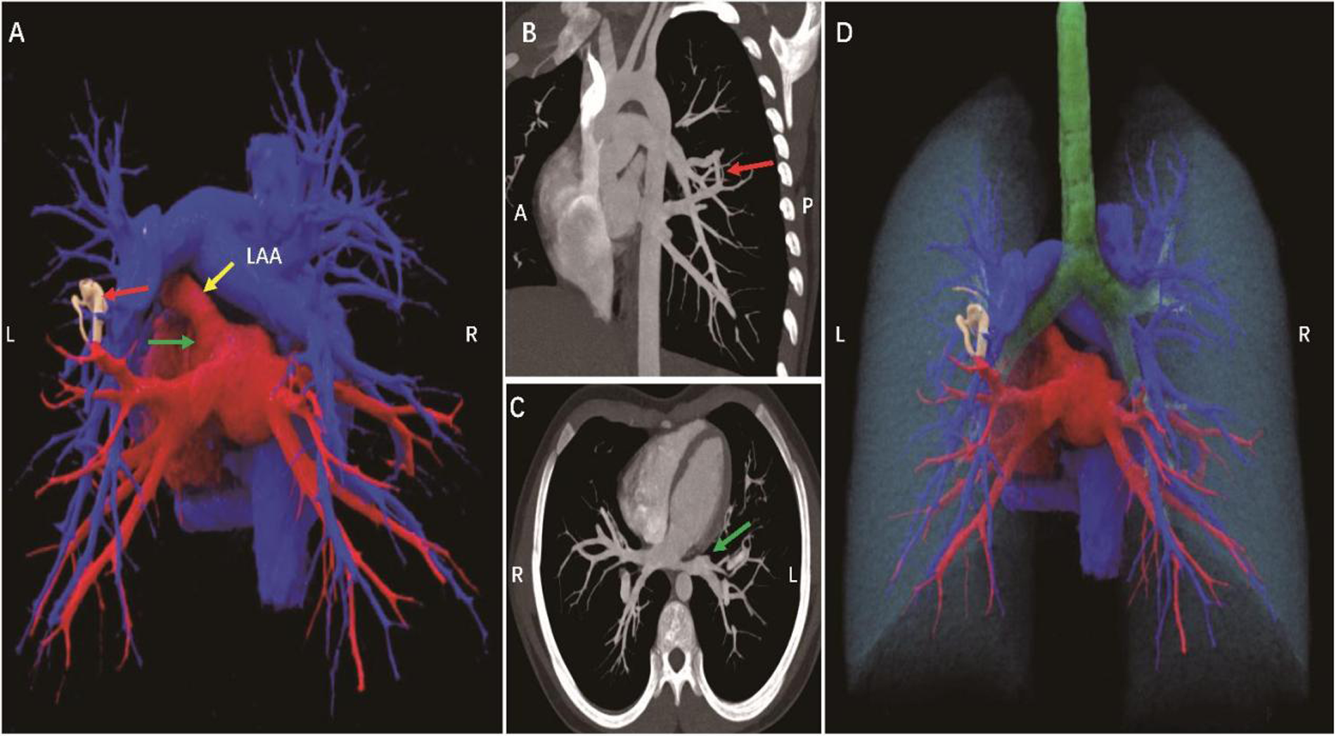 Composite of medical images showing the pulmonary vasculature and lungs. Panel A depicts a 3D reconstruction with colored arteries and veins. Panel B shows a sagittal CT scan highlighting a pulmonary artery. Panel C displays an axial CT slice featuring the heart and pulmonary vessels. Panel D presents a 3D representation of the lungs and trachea from the front. Arrows and labels identify specific anatomical features.