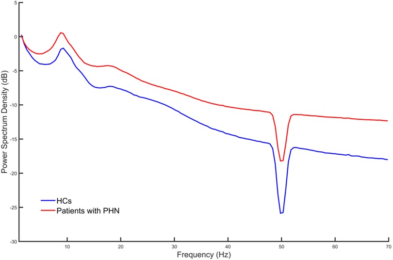 Line graph showing power spectrum density in decibels against frequency in Hertz. The red line represents patients with PHN, and the blue line represents healthy controls. Both lines dip significantly around 50 Hz, with the blue line generally lower than the red line.