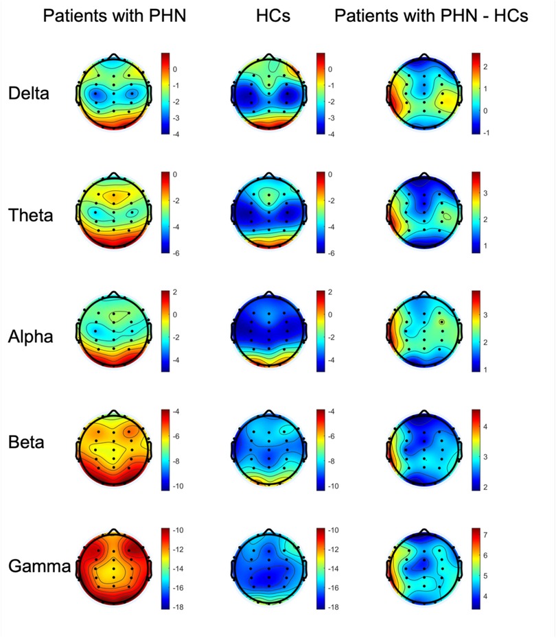 Comparison of EEG brain maps for patients with postherpetic neuralgia (PHN) and healthy controls (HCs) across different frequency bands: Delta, Theta, Alpha, Beta, and Gamma. The first column shows PHN patients, the second column shows HCs, and the third column displays the difference between the two groups. Color scales indicate varying activity levels, with red representing higher activity and blue representing lower activity. Each frequency band map highlights different neural activity patterns.